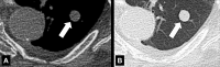 Nodule: Transverse CT images in (A) soft issue and (B) lung windows of the
right lung show a well-defined, solid soft tissue nodule (arrow). Note the small
pleural effusion. 