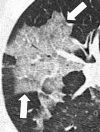 Septal thickening: Transverse CT image of the right upper lobe shows
irregular ground-glass opacities (arrows) with interlobular septal thickening
and intralobular lines in an area of crazy paving.