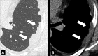 Pleural: Transverse CT images of the left lung in (A) lung and (B) soft
tissue window show diffuse nodular pleural thickening (arrows). 
