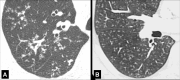 Tree-in-bud: (A, B) Transverse CT images of the right lung in two
different patients show focal tree-in-bud opacities. 