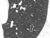 Incomplete: Transverse CT image of the left lung shows absence of the
medial portion (solid arrow) of the left major fissure (open arrow). 