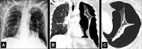 Pneumothorax: (A) Frontal chest radiograph, and (B) coronal and (C)
transverse CT image reconstructions of the lung show air in the left pleural
space loculated due to pleural adhesions. 