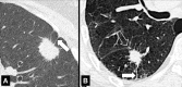 Nodule: Transverse CT images of the (A) left upper and (B) right lower
lobes show spiculated nodules with pleural tags (solid arrow) and fissural
involvement (open arrow). 
