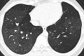 Oligemia: Transverse CT image shows areas of oligemia caused by small
airways disease. Note the reduced number of vessels and thickened bronchial
walls. 