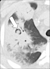 Air crescent: Transverse CT image of the right upper lobe shows air
crescent (arrow) caused by angioinvasive aspergillosis. 