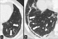 Parenchymal band: Transverse CT images of the (A) left and (B) right lung
of two different patients show linear parenchymal bands paralleling the pleura
(arrows). Pattern. 