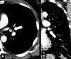 Endobronchial: (A) Transverse and (B) coronal contrast-enhanced CT images
through left lung of the same patient show endobronchial lesion in left upper
lobe bronchus (arrow). 