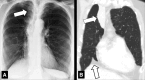 Atelectasis: (A) Frontal chest radiograph and (B) coronal CT image
reconstruction show right upper lobe atelectasis (solid arrow). Note presence of
juxtaphrenic peak in B (open arrow). 