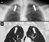 Apical cap: (A) Frontal chest radiograph and (B) coronal CT image
reconstruction in the same patient show bilateral apical caps (arrows). 