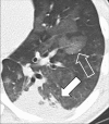 Consolidation with peripheral ground-glass: Transverse CT image of the
left lower lobe shows consolidation (solid arrow) and ground-glass opacities
(open arrow). 