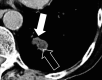 Nodule: Transverse CT image of the left lower lobe shows a complex nodule
with fat (open arrow) and soft tissue (solid arrow) components. 