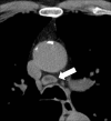 Lymph node: Transverse CT image of the mediastinum shows mediastinal lymph
node (arrow) with fatty hilum. 