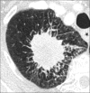 Spiculation: Transverse CT image of the right upper lobe shows a
spiculated mass. 