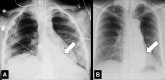 Atelectasis: Frontal chest radiographs of two different patients with
complete left lower lobe atelectasis (arrow) show that the size of the
atelectatic lobe can vary from (A) large to (B) small. 