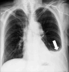 Effusion: Frontal chest radiograph shows left pleural effusion (arrow). 
