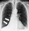 Atelectasis: Frontal chest radiograph shows right lower lobe atelectasis
(arrows). 