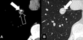 Nodule: Transverse CT images in (A) soft tissue and (B) lung windows of
the right lower lobe show a complex nodule with a calcified (solid arrow) and
soft tissue (open arrow) component. 
