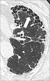 Honeycombing: Transverse CT image of the left lung shows honeycombing
(arrow). 