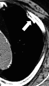 Plaque: Transverse CT image of the left upper lobe shows calcified pleural
plaque (arrow). 