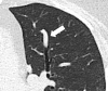 Mucoid impaction: Transverse CT image of the left upper lobe shows
bronchus impacted by mucus (arrow). 