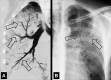 Air bronchogram: (A) Coronal CT image reconstruction of the right lung and
(B) frontal chest radiograph of the left lung show air bronchograms (arrows). 
