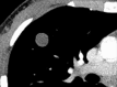Nodule: Transverse CT image of the right upper lobe shows a round,
well-defined, solid soft tissue nodule. 