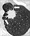 Nodule, spiculation, pleural tag: Transverse CT image of the left upper
lobe shows a spiculated nodule with pleural tags (arrows). 