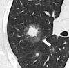 Halo: Transverse CT image of the right lung shows a ground-glass halo
(arrow) surrounding central nodular consolidation. 