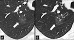 Nodule: Transverse CT images of the right lung show the evolution of a
nodule from (A) a ground-glass nodule (arrow) to (B) a nodule with ground-glass
(solid arrow) and soft tissue and cystic (open arrow) components. 