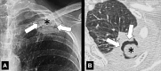  Air crescent: (A) Frontal chest radiograph and (B) transverse CT image of
the left upper lobe show rim-like air crescents (arrows) surrounding a mycetoma
(asterisks) within a preexisting cavity. 