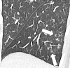 Tree-in-bud: Sagittal CT image reconstruction of the left lower lobes
shows focal tree-in-bud opacities (arrows). 