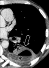 Empyema: Transverse contrast-enhanced CT image of the left lower lobe
shows empyema (asterisk) with air-fluid level, surrounded by thickened and
enhancing pleura (solid arrow), with adjacent atelectasis (open arrow). 