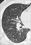 Miliary: Transverse CT image of the right lung shows miliary micronodules. 