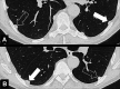 Pleural: (A, B) Transverse CT images of the lung bases show focal pleural
nodules (solid arrow), some of which are partially calcified (open arrow). 