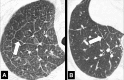 Septum: (A, B) Transverse CT images of the right upper lobe in two
different patients show thickened interlobular septa (arrow). 
