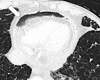 Pneumopericardium: Transverse contrast-enhanced CT image shows ventral
pericardial air collection (arrow). 
