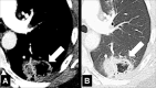 Cavity: Transverse contrast-enhanced CT image of the left lower lobe shows
(A) soft tissue and (B) lung window of gas-filled structure with thickened and
irregular walls (arrow). 