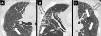 Architectural distortion: Transverse CT images of the (A, B) right and (C)
left lung of three different patients show traction bronchiectasis (solid
arrows). Note the presence of coexisting fibrosis and architectural distortion
(open arrow in B and C).
