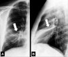 Atelectasis: (A) Frontal and (B) lateral chest radiograph of the same
patient show middle lobe atelectasis (arrow). 