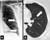 Pneumothorax: (A) Frontal chest radiograph and (B) transverse CT image
reconstruction of the left lung show air in the pleural space (arrows). 