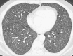 Miliary: Transverse CT image of the lungs show diffuse distribution of
micronodules. 