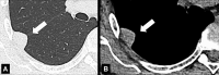Pleural: Transverse CT images of the right lower lobe in (A) lung and (B)
soft tissue window show focal pleural lesion (arrow). 
