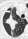 Mass: Transverse CT image of the right upper lobe shows mass with
spiculations (open arrow) and pleural tags (solid arrow). 