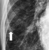 Septal thickening: Frontal chest radiograph shows septal lines (arrow). 