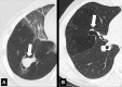 Bronchocele: Transverse CT images of the right lung in two different
patients show localized bronchial dilatation (A) with and (B) without mucoid
impaction within a hyperlucent lobe, due to congenital bronchial atresia
(arrow). 
