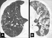 Three Attenuation: Transverse CT images in two different patients through
the (A) right and (B) left lung show lobules with normal, increased, and
decreased attenuation. 