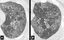 Crazy paving: (A, B) Transverse CT images of the left lung of two
different patients show crazy-paving pattern. 