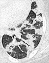 Organizing pneumonia: Transverse CT image of the left lower lobe shows
consolidation with perilobular and peribronchovascular distribution. 