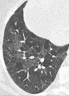 Mosaic: Transverse CT image of the right lung shows mosaic pattern. 