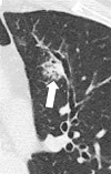 Bronchocentric: Transverse CT image of the left upper lobe shows
bronchocentric opacity (arrow). 